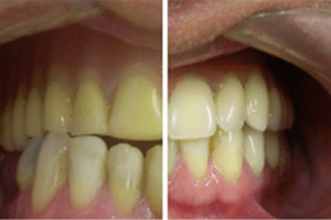 Imagem 2 de Dentadura
